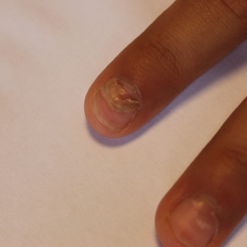 Proximale loslating nagelplaat