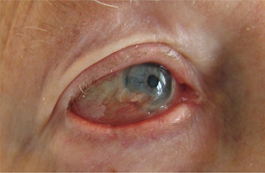 Ectropion van het rechter oog, het onderste ooglid ligt niet meer tegen het oog aan en is rood door onvoldoende bevochtiging