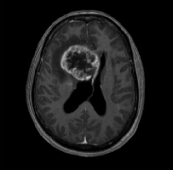 Axiale coupe van de MRI-hersenen: we zien een grillig ruimte-innemend proces rechts frontaal met contrastaankleuring, met een omringend vasogeen oedeem, midline shift en doorgroei in de falx cerebri.