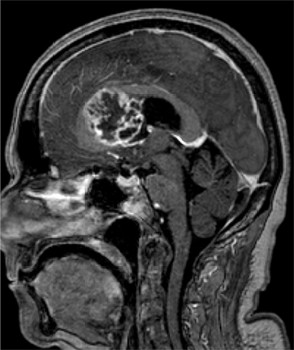 Sagitale coupe van de MRI-hersenen; zie de omschrijving van figuur .