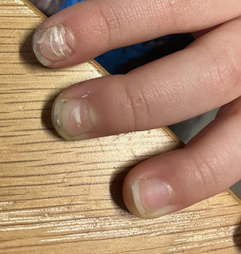 Loslatende nagels