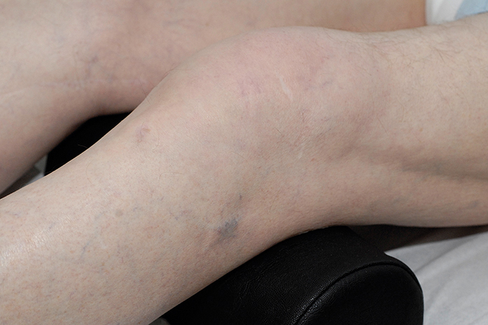 Aspiratie en injectie bij zwelling van de knie | H&W