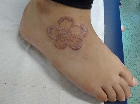 Uil volwassene Ambassade Allergische reactie na permanente tatoeage | Huisarts & Wetenschap
