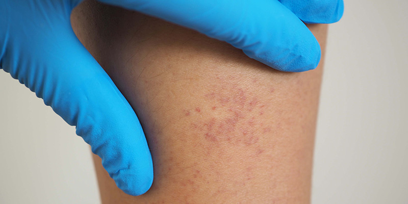 trombocytopenie behandeling