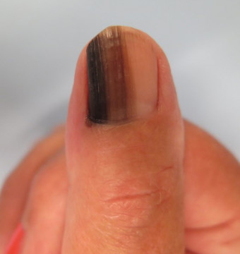 Bruin verkleurde nagel
