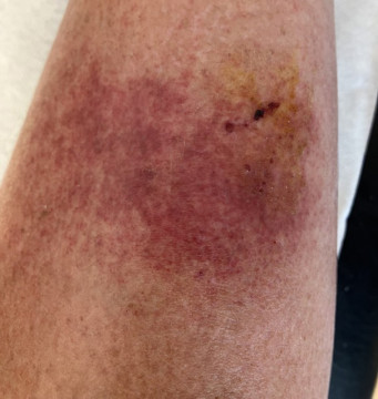 Rode plek op scheenbeen