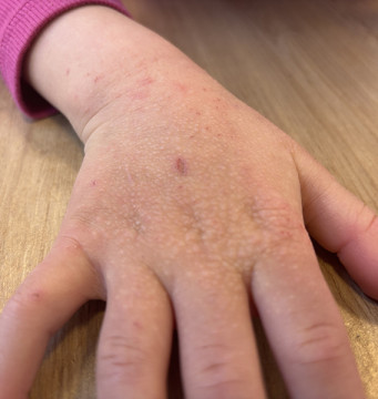 Hand van een 5-jarig meisje met hevig jeukende papeltjes.