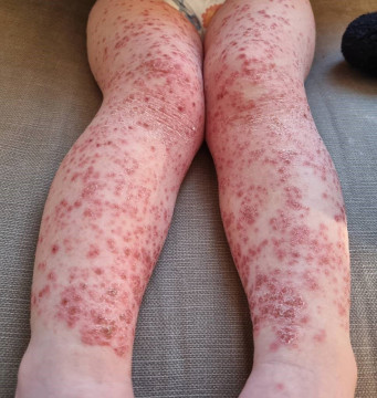 Huiduitslag op benen van 2-jarige