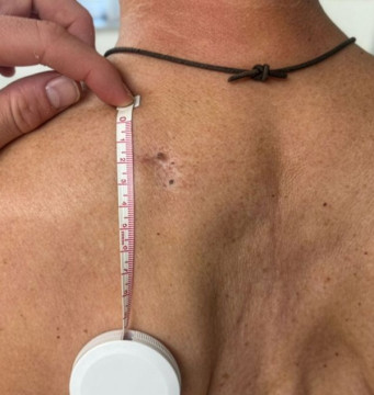 Huidafwijkingen in een litteken 