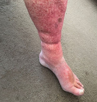 Rood en gezwollen been