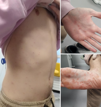 Collage rode vlekjes op het lichaam