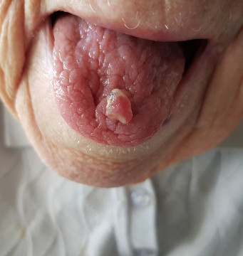 Afwijking op de tong