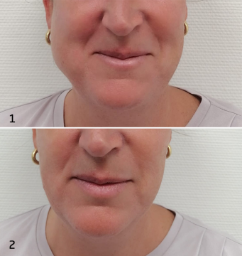 Twee keer foto van wang, bovenste met zwelling, onderste zonder zwelling