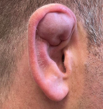 Een zwelling in het oor