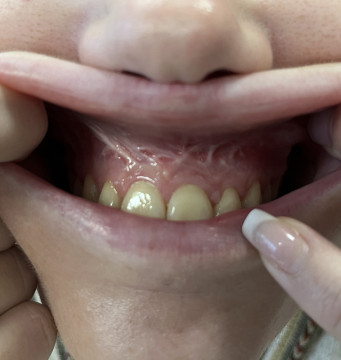 Witte lijnen in het tandslijmvlies