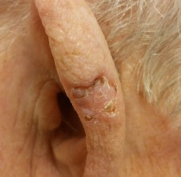 Poll plek op het oor