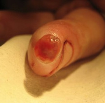 Poll Wond bij diabetes