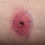 Erytheem