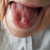 Afwijking op de tong