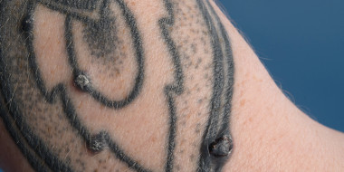 Tatoeage met bultjes