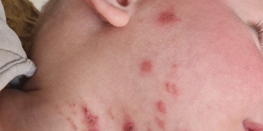 DAV_erythemateuze uitslag