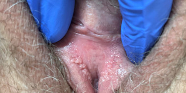 Bultjes op vulva