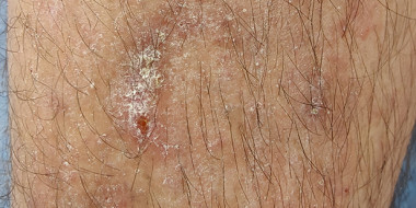 jeukende huidafwijking