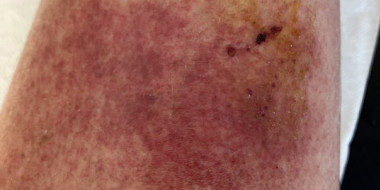 Rode plek op scheenbeen