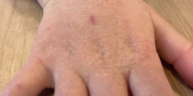 Hand van een 5-jarig meisje met hevig jeukende papeltjes.