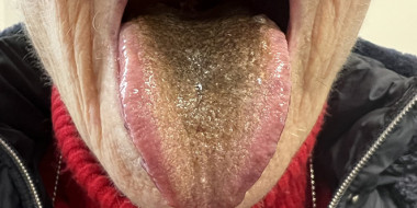 Zwarte tong bij 85-jarige vrouw