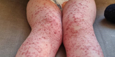 Huiduitslag op benen van 2-jarige