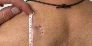 Huidafwijkingen in een litteken 