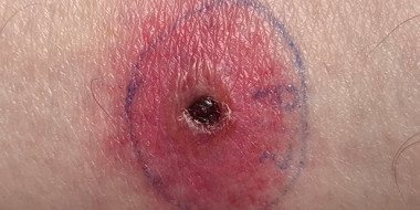 Erytheem