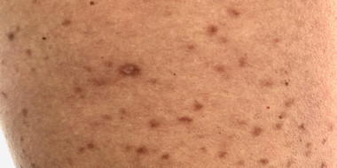 Pigmentvlekken op de bovenbenen