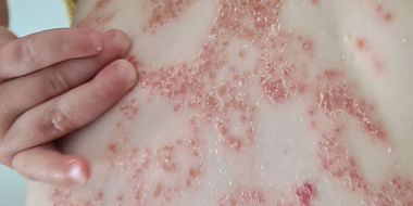 Eczeem op de rug van een peuter