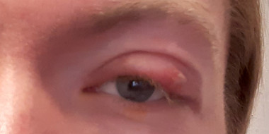 Plekje op ooglid