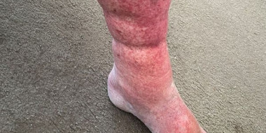 Rood en gezwollen been