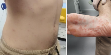 Collage rode vlekjes op het lichaam