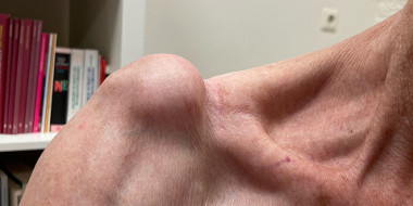 Zwelling op een schouder