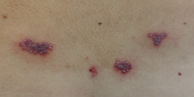 Blaasjes op de onderrug