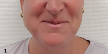 Twee keer foto van wang, bovenste met zwelling, onderste zonder zwelling