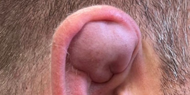 Een zwelling in het oor