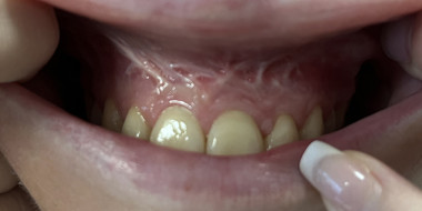 Witte lijnen in het tandslijmvlies