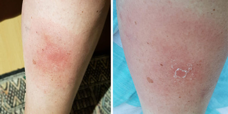 Erythema migrans