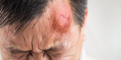 Man met bult en schram op hoofd