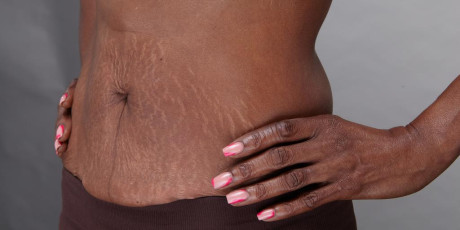 Buik van een vrouw met een donkere huidskleur met striae