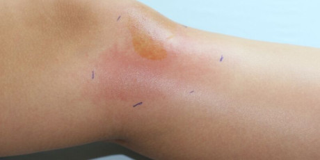 Wat is de effectiefste dosering van flucloxacilline om cellulitis te behandelen? Foto: Shutterstock