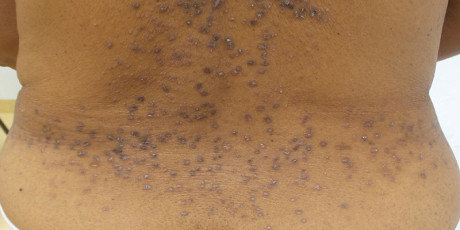 Lichen planus: andere presentatie op donkere huid, wees alert. Foto: Shutterstock
