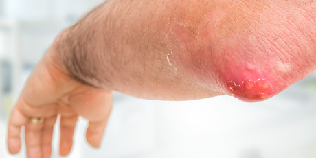 Bacteriële huidinfectie