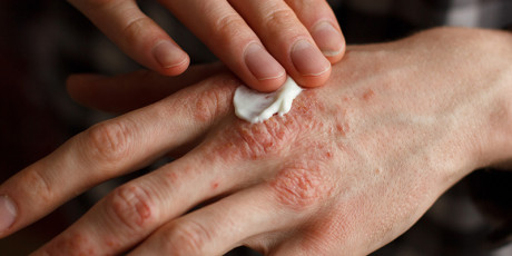 Krachtig corticosteroïd